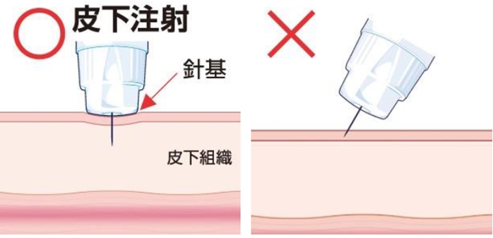 109回薬剤師国家試験問202　ゾルトファイ配合注フレックスタッチ